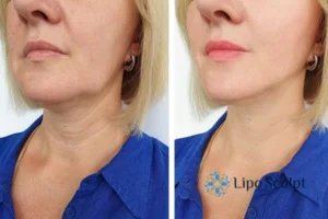 Double chin before and after Hi-Fu treatment 4 Book your double chin treatment Ryton on Dunsmore today! We are here to help!