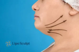 Double chin before and after Hi-Fu treatment 3 Boost your confidence with a Double chin treatment Ryton on Dunsmore