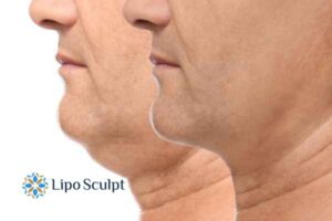 Double chin before and after Hi-Fu treatment 2 Double chin treatment Ryton on Dunsmore from Lipo Sculpt - feel more confident today!