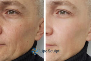 How to Fight Aging Symptoms 3 Fight Aging Symptoms Ryton on Dunsmore With HIFU and Morpheus8 Today!