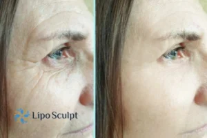 How to Fight Aging Symptoms 2 Do you want to Fight Aging Symptoms Ryton on Dunsmore? Contact Lipo Sculpt today!