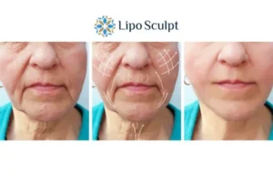Explaining Morpheus8 And What It Can Do For You 3 Boost your confidence with Morpheus8 Ryton on Dunsmore call our team today!