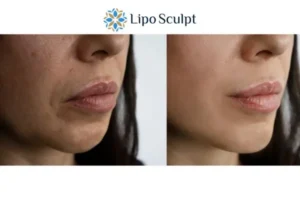 Explaining Morpheus8 And What It Can Do For You 4 Morpheus8 Ryton on Dunsmore the best results - call our team today!