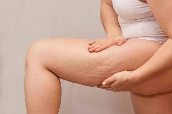 Find the best cellulite treatment Ryton on Dunsmore for you!