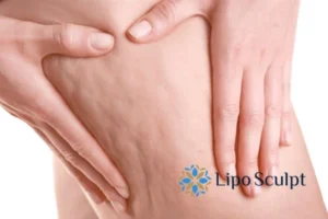 CoolSculpting for Legs: The Innovative Approach to Redefining Your Legs 5 Start your journey today book your coolsculpting treatment Ryton on Dunsmore online today!