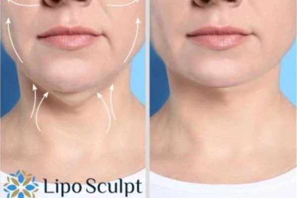 Book your Chin Reduction Treatment Ryton on Dunsmore today! Call Lipo Sculpt NOW!