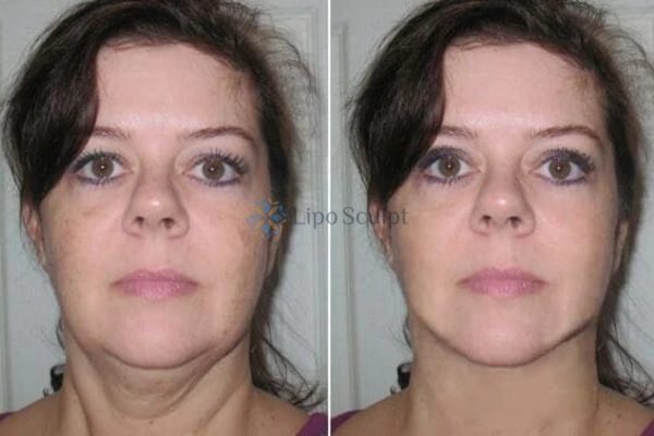 Chin Reduction Treatment Ryton on Dunsmore - Aqualyx treatment