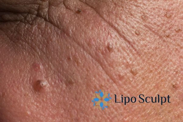 Remove skin lesions in as little as one treatment for an anti ageing Ryton on Dunsmore effect!